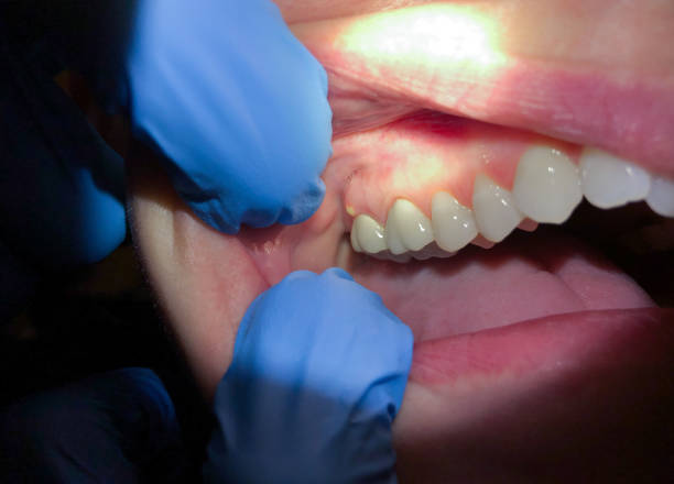 Best Emergency Treatment for Oral Infections in Palm Valley, FL